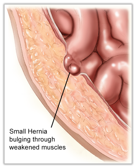 what is a hernia - Early Hernia Formation