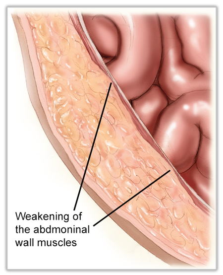 what is a hernia - Early Abdominal Wall Hernia