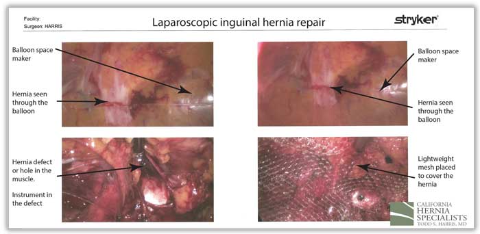 How does the laproscopic surgery repair a hernia?