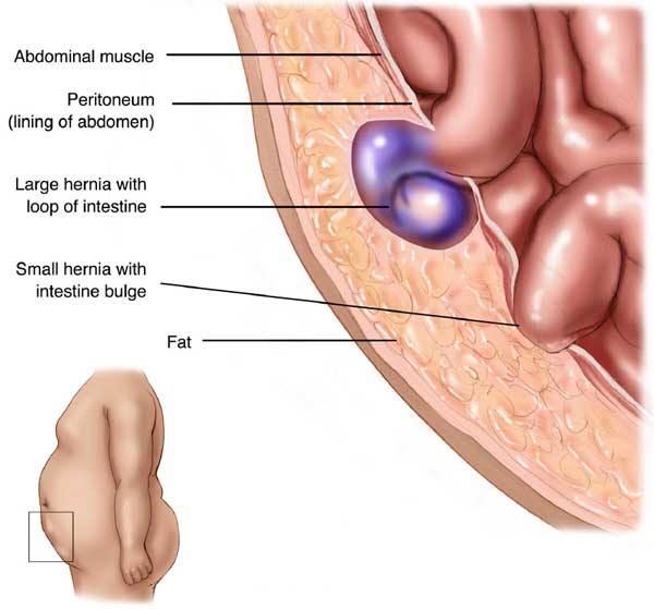 what is a hernia - Strangulated Ventral Hernia Side View