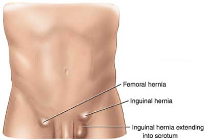 Types of Hernias - California Hernia Specialists