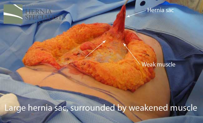 Open Incisional Hernia Repair