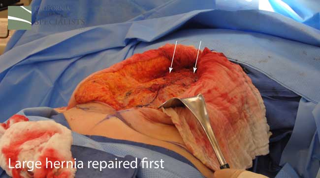 Open Incisional Hernia Repair