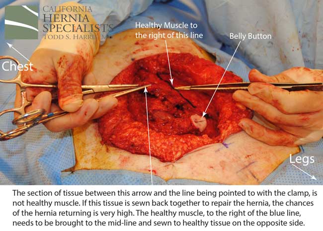 Open Incisional Hernia Repair Component Separation