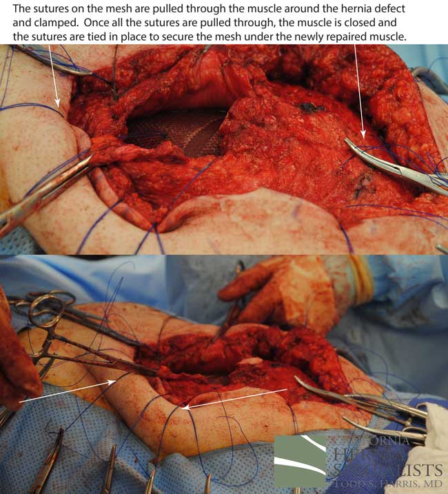 Open Incisional Hernia Repair Component Separation