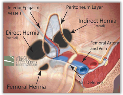 Inguinal Hernia Anatomy