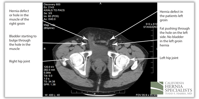 Recent Case Highlights - California Hernia Specialists