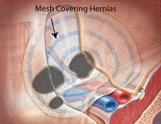 Open Hernia Repair