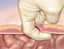 Hernia Types - Umbilical Dissection