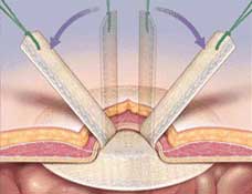 Hernia Types - Umbilical hernia sutured