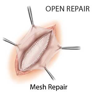 Open Mesh Repair